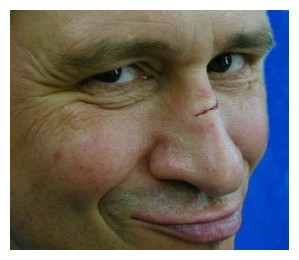 verschorfte Wunde auf dem Nasenbein