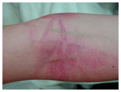 Neurodermitis am Ellbogen