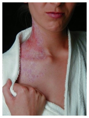 Neurodermitis am Hals