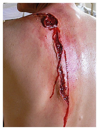 R�ckenschnittwunde
