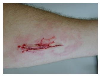 Schnittwunde Innenseite Unterarm