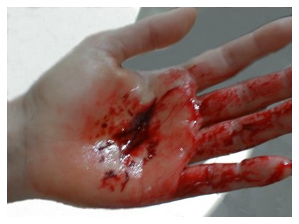 Schnittwunde Handinnenfl�che