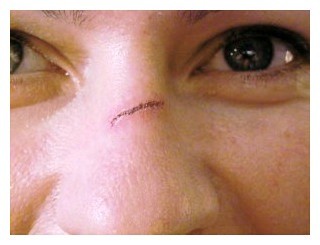 verschorfte Wunde auf der Nase