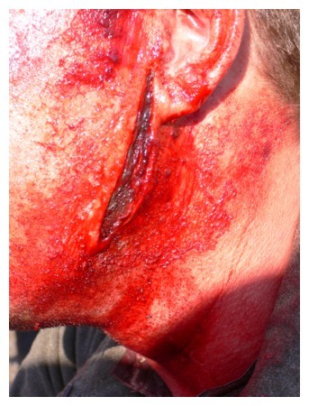 Unterkieferschnittwunde