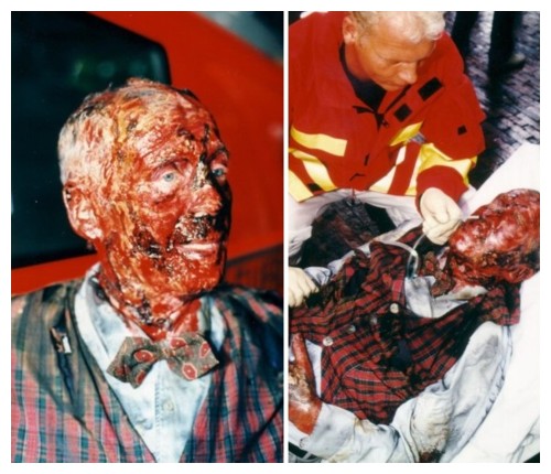 Schwere Verbrennungen