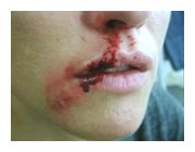 Wunde an Nase und Lippe